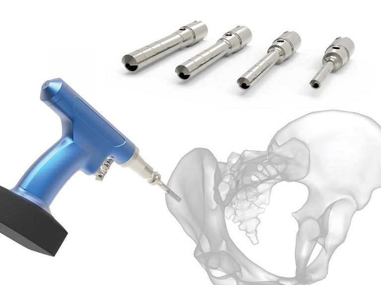 Bone Graft Harvesting System Acumed