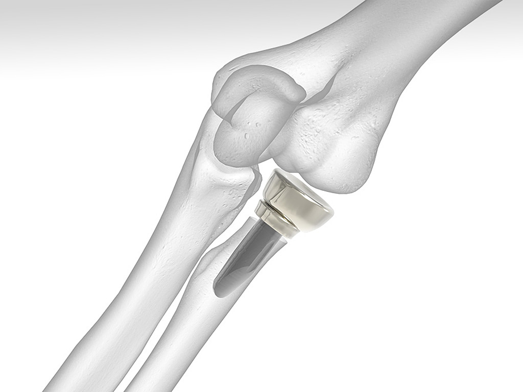 Anatomic Radial Head System | Acumed