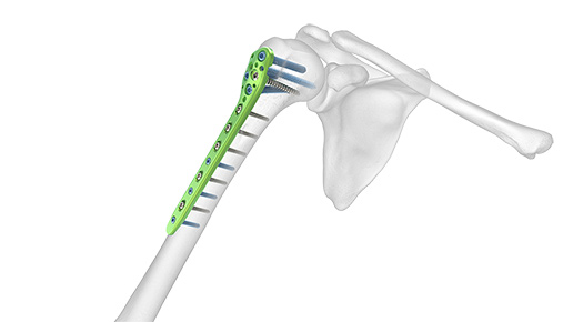 Polarus Proximal Humeral Plating (PHP) System