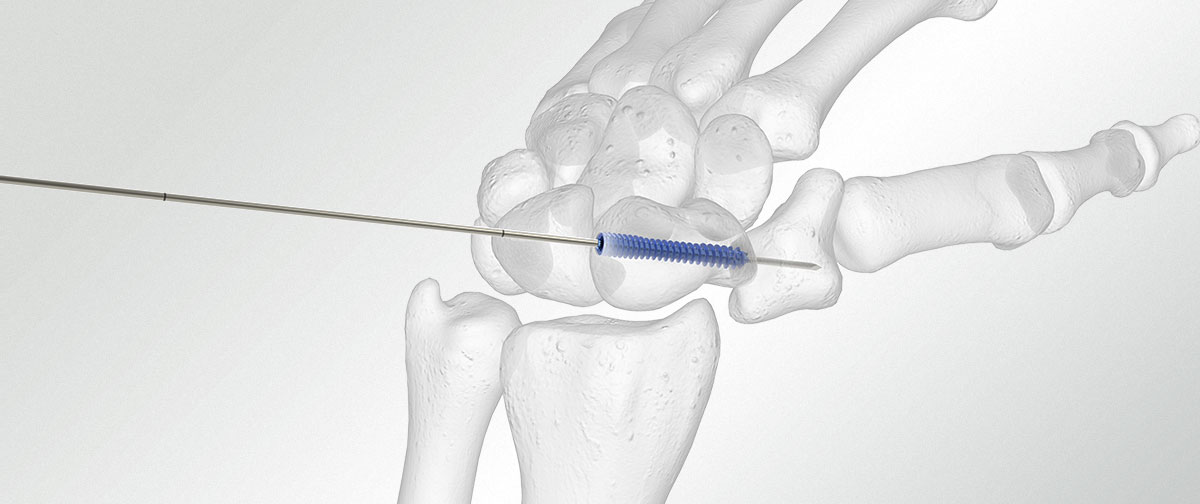 Headless compression screw insertion