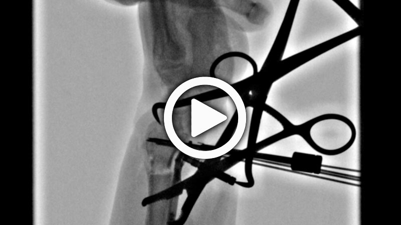 Acu-Loc 2 Volar Distal Radius Plate and Volar Tilt Correction Cadaveric Surgery with Dr. Ruch | Acumed