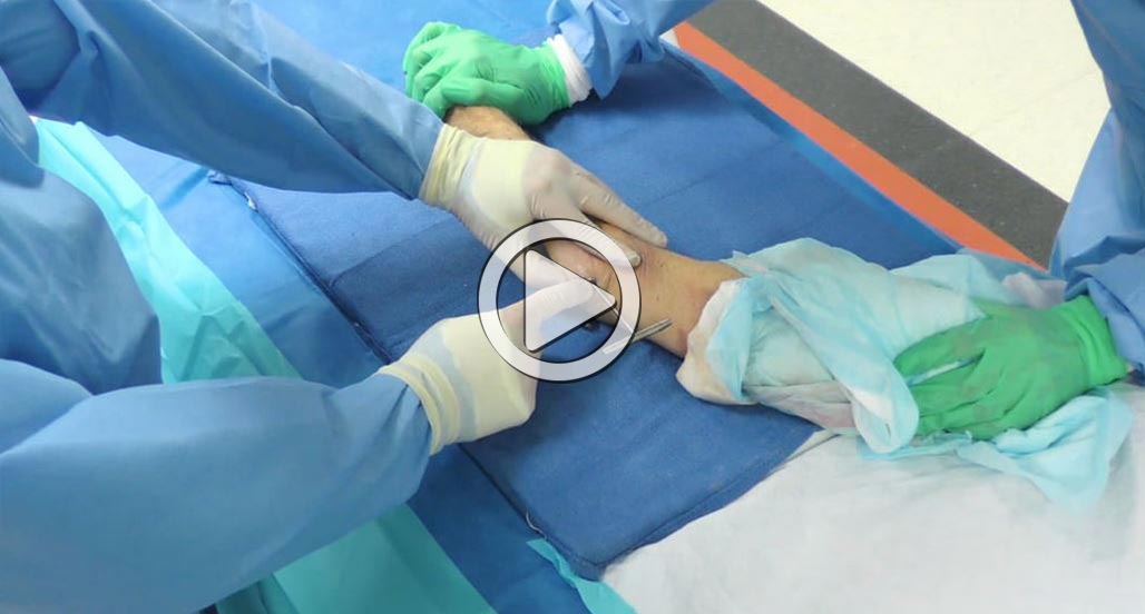 Ulna Fracture Treatment Using the Ulna Rod, with Dr. Richard – Acumed