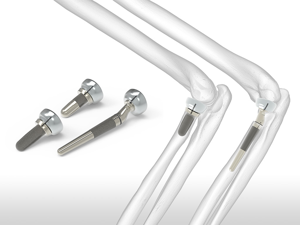 Anatomic Radial Head Solutions 2 Acumed