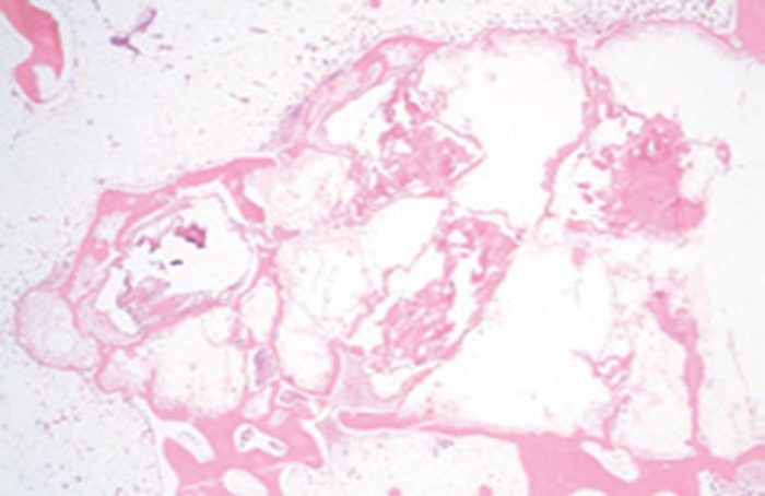 Trabexus
