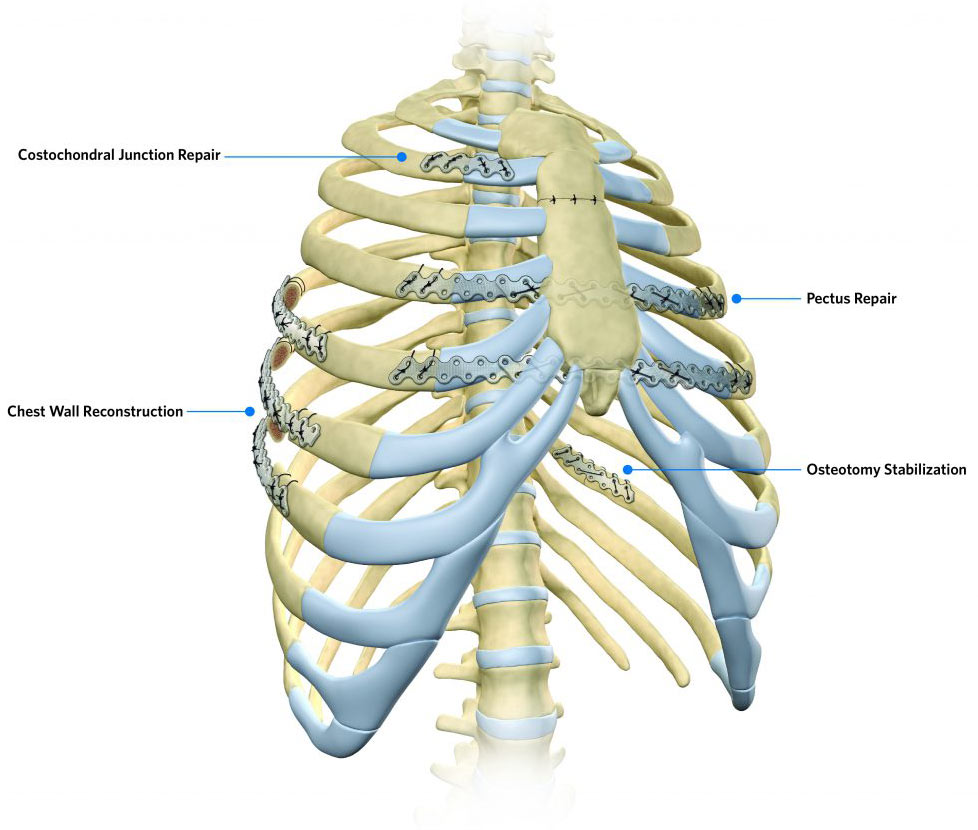 Standard Volar Distal Radius Plates