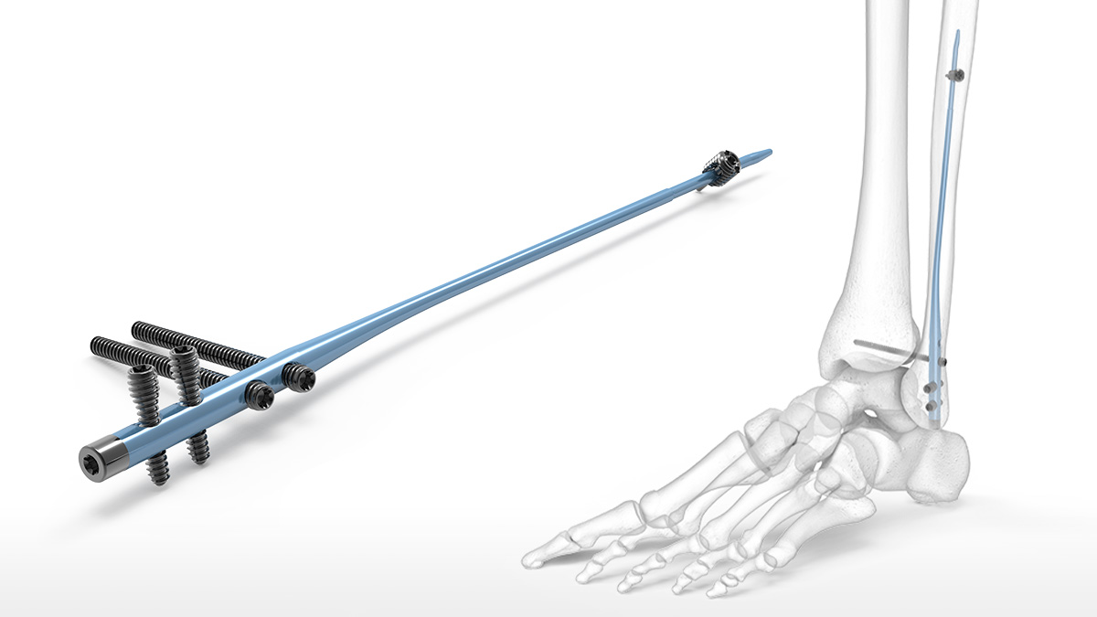 Titanium Cannulated Tibial Nail-EX | DePuy Synthes | J&J MedTech US