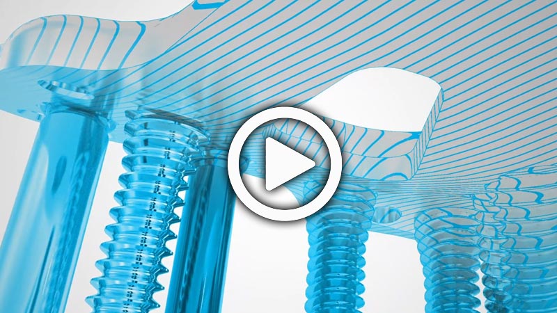 Acu-loc 2 Wrist Plating System with 2.7 mm Low-Profile Hexalobe Screws Overview Animation | Acumed