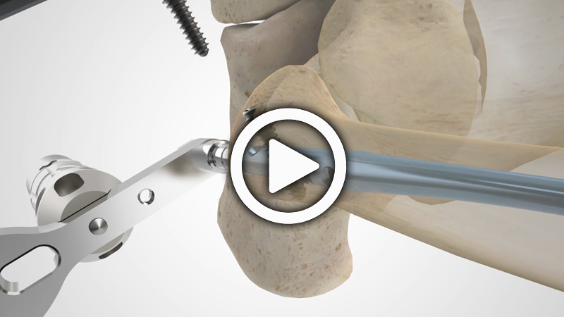 Fibula Nail 2 System Overview Animation | Acumed