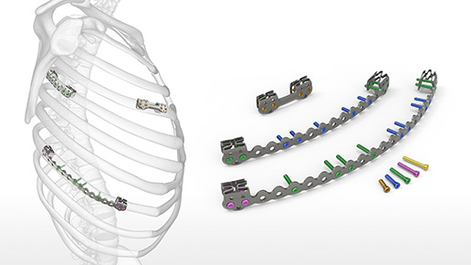 RibLoc U Plus Chest Wall Plating System