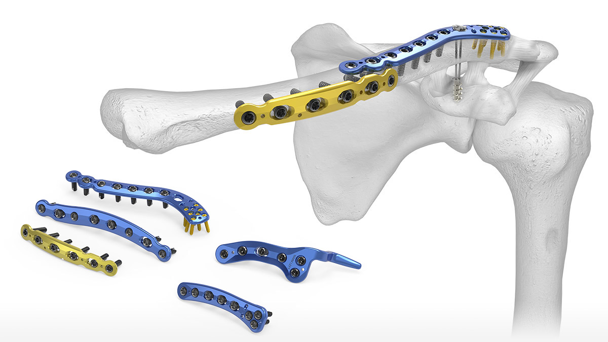 Jayon-Implants | RECON-F