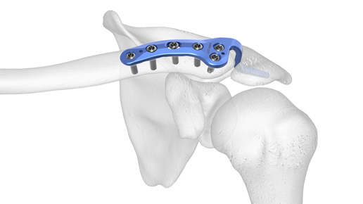 The Acumed Distal Clavicle Plate is designed to provide fracture fixation and stability for lateral third clavicle fractures, malunions, and nonunions, and where there is disruption to coracoclavicular (CC) ligaments. Multiple distal screw configurations are designed to achieve construct stability, while screw positioning targets distal fragments to provide secure, stable fixation for multiple fracture patterns.