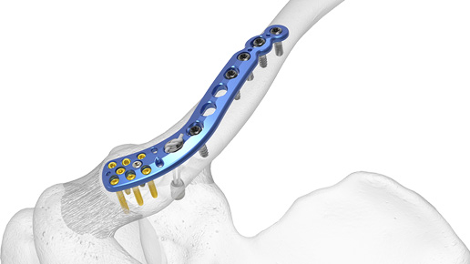 The Acumed Distal Clavicle Plate is designed to provide fracture fixation and stability for lateral third clavicle fractures, malunions, and nonunions, and where there is disruption to coracoclavicular (CC) ligaments. Multiple distal screw configurations are designed to achieve construct stability, while screw positioning targets distal fragments to provide secure, stable fixation for multiple fracture patterns.