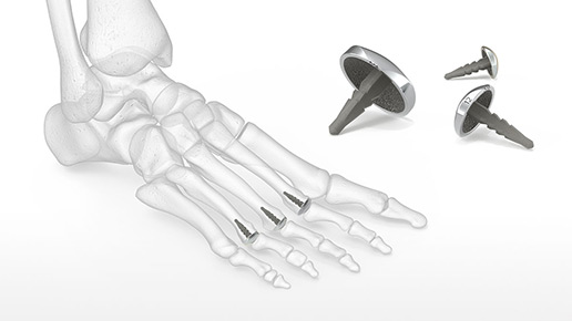 EnCompass Metatarsal Resurfacing Implant