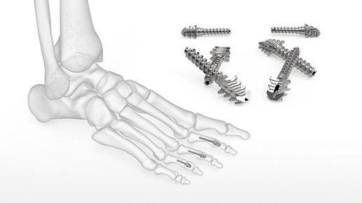 ExtremiFuse Hammertoe Fixation System