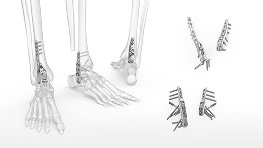 ExtremiLock Ankle Fusion Plating System