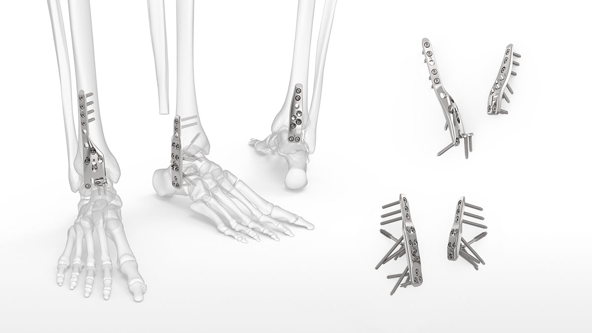 Figure 3 from The success of tibiotalocalcaneal arthrodesis with  intramedullary nailing--a systematic review of the literature. | Semantic  Scholar