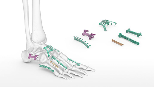 FPS Foot Plating System