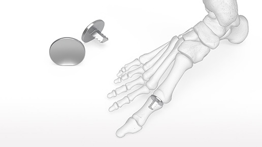 Hemi Great Toe Implant