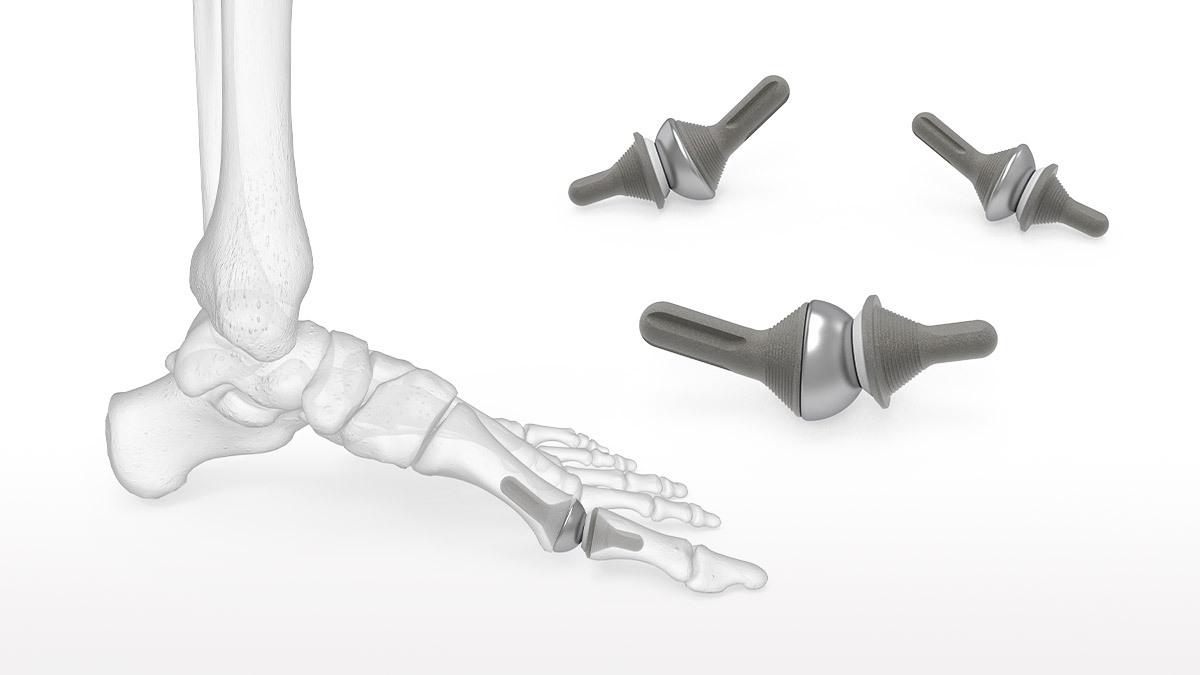 OsteoMed ReFlexion 1st MTP Implant System | Acumed