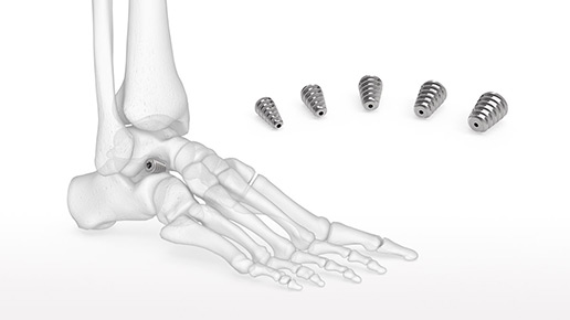 Talar-Fit Subtalar Arthrodesis Implant
