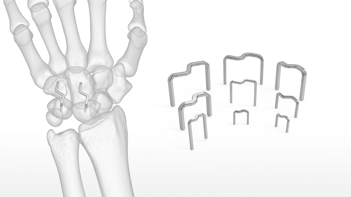 OsteoMed InstaFix Shape Memory Fixation System