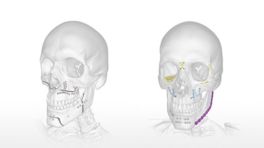 Acumed Elbow Solutions