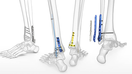 Acumed Foot & Ankle Solutions