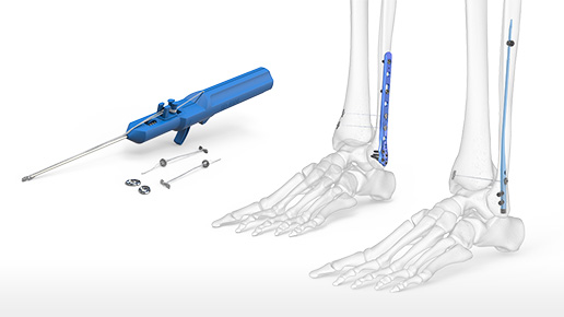 Ankle Syndesmosis Repair System