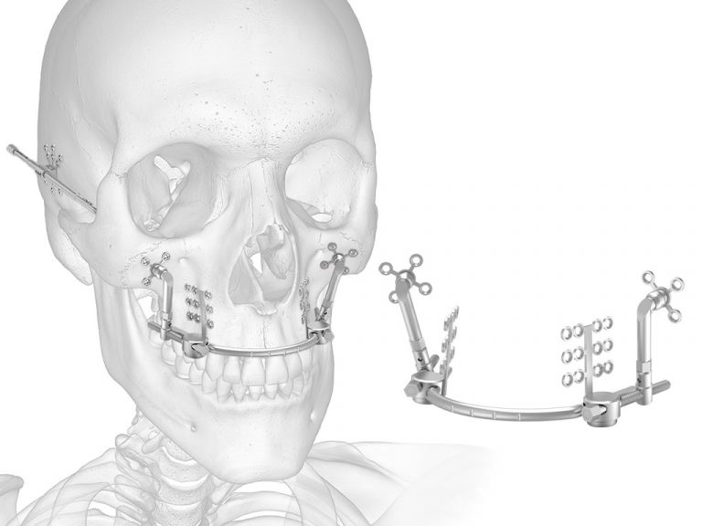 Spectrum LeFort III Midface Distraction System Acumed