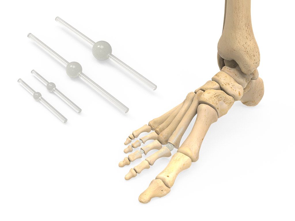InterPhlex Flexible Stabilization Rods | Acumed