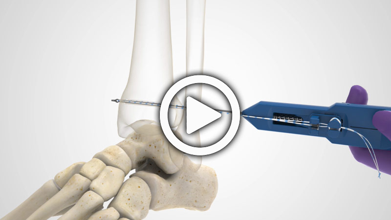 Ankle Syndesmosis Repair System with Acu-Sinch Knotless Surgical Technique Animation | Acumed