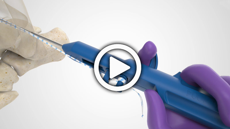 Ankle Syndesmosis Repair System with Acu-Sinch Knotless Overview | Acumed