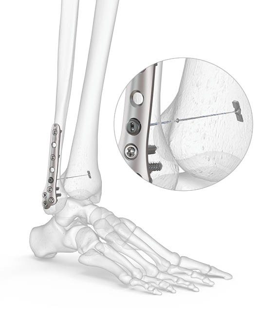 OsteoMed ExtremiLock Ankle Plating System | Acumed