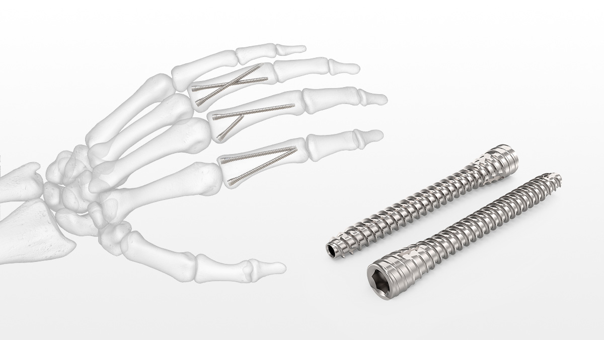 7. Complications Associated with Brooker-Wills Interlocking Intramedullary Nail Design - wide 5