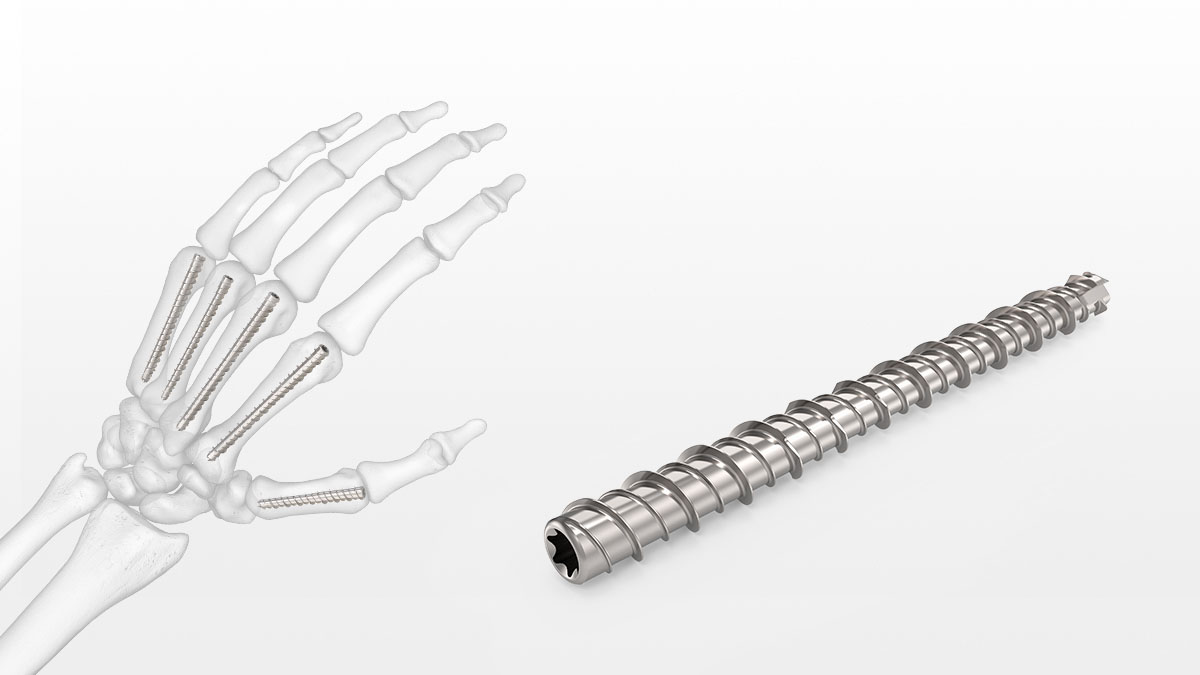 Limb Salvage: The Infected Retrograde Tibiotalocalcaneal Intramedullary Nail  - Christopher Bibbo, Simon Lee, Robert B. Anderson, W. Hodges Davis, 2003