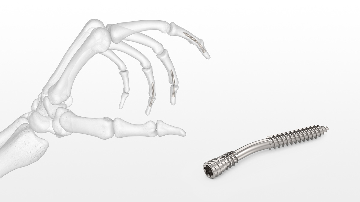 ExsoMed ArcPhix Functional Flexion Compression Screw