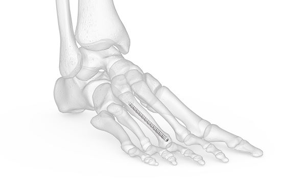 A New Technique For Tibiotalar Arthrodesis: Shotel Ankle Arthrodesis Nail  System | Published in SurgiColl