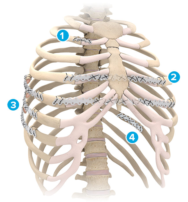 Standard Volar Distal Radius Plates