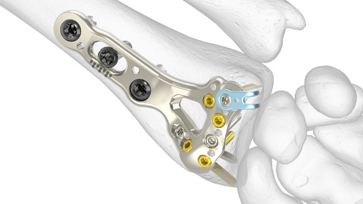 Standard Volar Distal Radius Plates