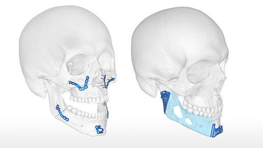 Pelvic Plating System