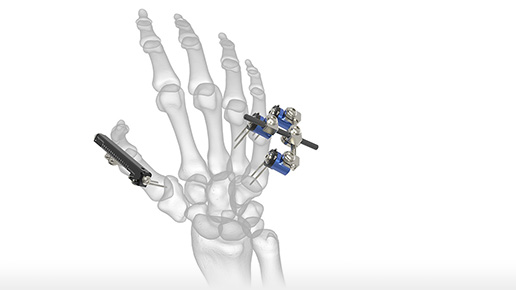 External Fixation System